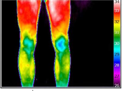 How is Infrared Thermal Imaging Technology Applied in the Field of Sports Rehabilitation?